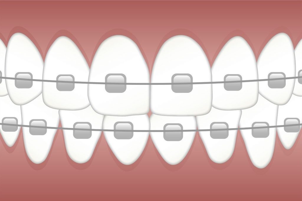 How to look after your fixed braces?
